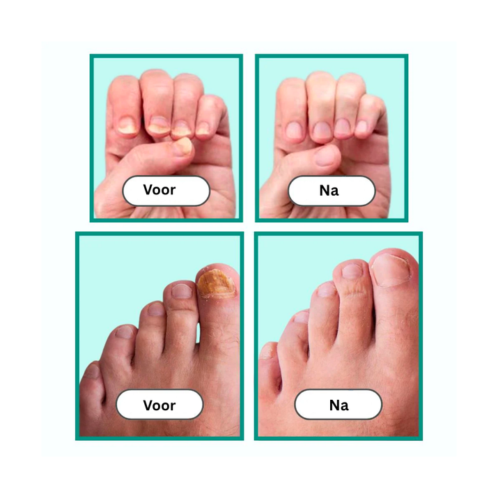 OnlyClear™ Laserbehandeling voor Schimmelnagels