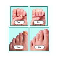 OnlyClear™ Laserbehandeling voor Schimmelnagels